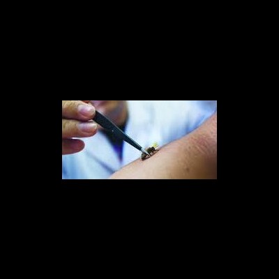 Pinças Apanhar Abelhas