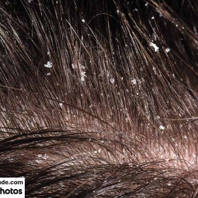 Couro cabeludo com caspa visível em cabelo castanho escuro