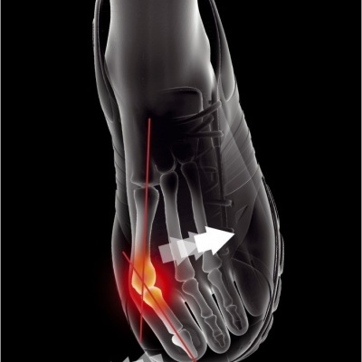 Epitact Sport Órtese Hallux Valgus Tam. L