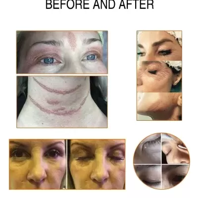 Caneta Jato de Plasma Fibroblast Ozônio