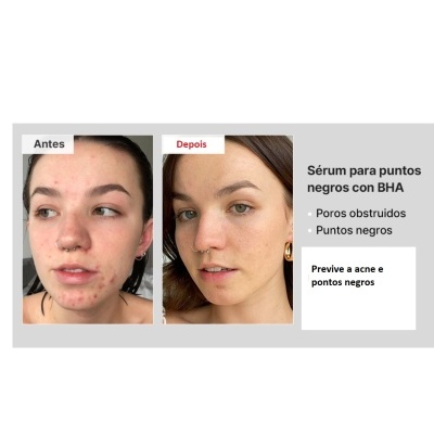 Sérum Eliminador de Pontos Negro BHA 4%