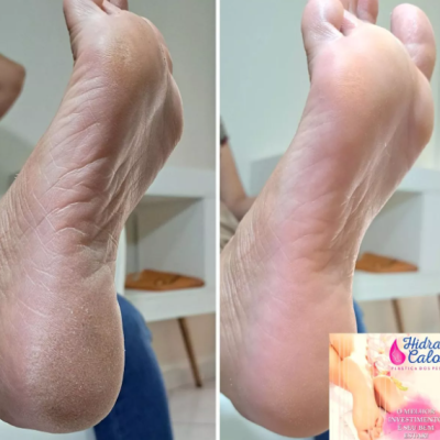 Hidracalo 300ml Loção Emoliente - Plástica dos Pés