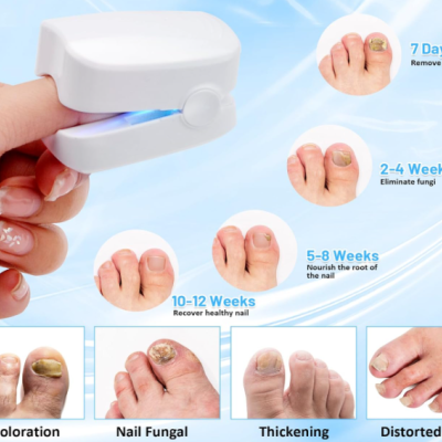 Máquina a Laser para Limpeza de Fungos nas Unhas