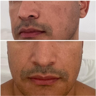 Bio Sérum Facial Vitamina C, E, Ácido Hialurónico Puro. Para Rosto e Contorno dos Olhos. Também para Dermaroller