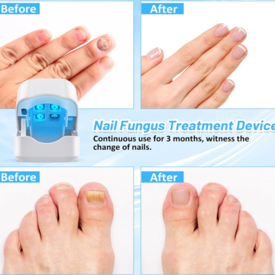 Máquina a Laser para Limpeza de Fungos nas Unhas