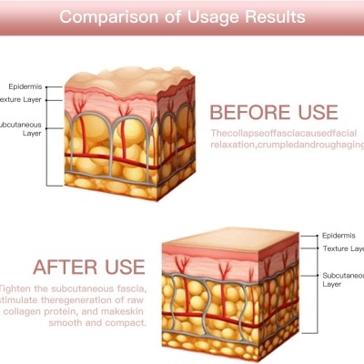 Mini Hifu Pro 3 em 1 Ultrassom Focalizado Radiofrequência Remodelador e Lifting Facial