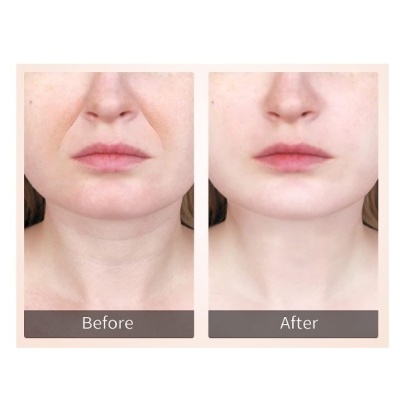 Massajador EMS Lifting & 45 °C Rosto Pescoço