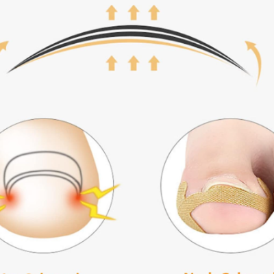 Kit Unhas Encravadas dos Pés