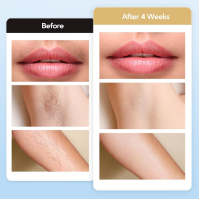 Depiladora de Luz Pulsada com Alta Energia