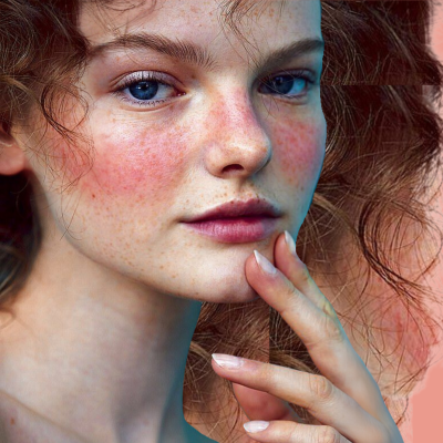 Rosácea