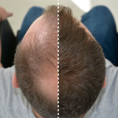 Cabeça de homem vista de cima dividida ao meio mostrando antes e depois do cabelo
