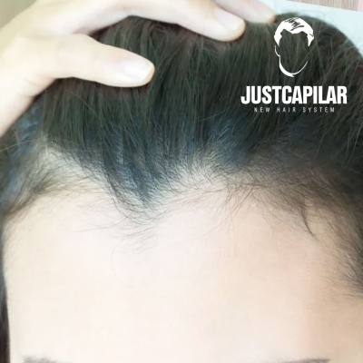 Prótese Capilar Frontal HD (Bleadched Knots) cabelo 30cm