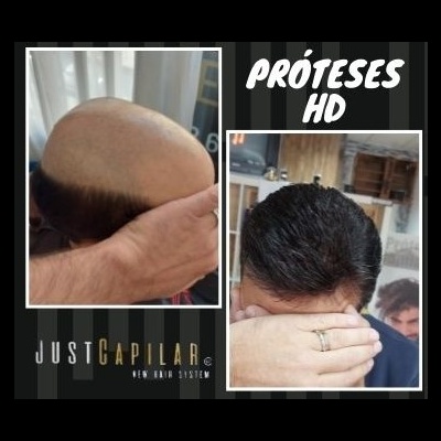 Clínica Justcapilar em Lisboa