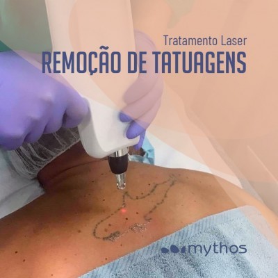 Remoção Tatuagens e Micropigmentação