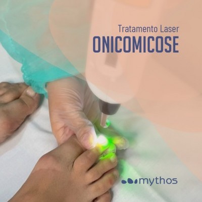 Tratamento Onicomicose - Fungos na Unhas