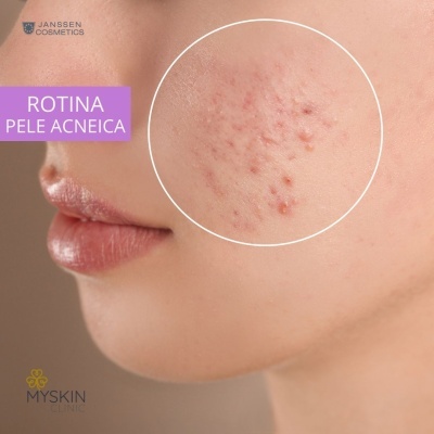 Kit Skincare Pele Acneica