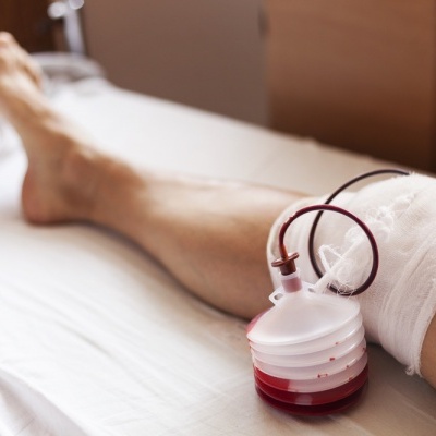 Dreno Cirúrgico de Sucção