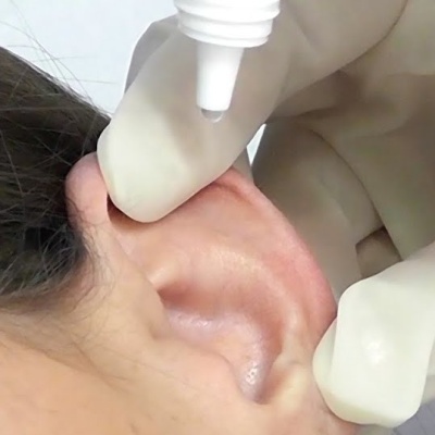 Acetonido de fluocinolona + Neomicina + Polimixina B (Oto-Synalar N) Gotas auriculares, Associação