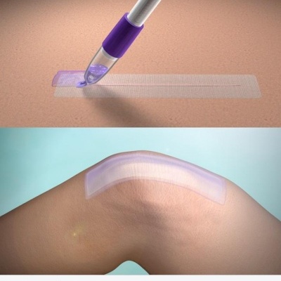 DERMABOND PRINEO Skin Closure System