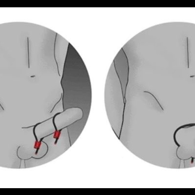 Ilustrações a cinzento do corpo masculino a mostrar áreas específicas no pénis com linhas vermelhas.