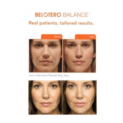 Belotero&#x20;Balance&#x20;Lidocaine&#x20;1ml