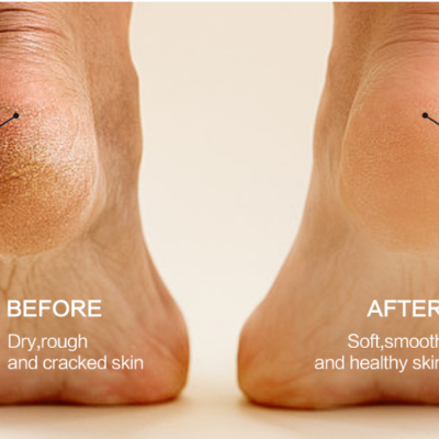 Lima Elétrica Remover Calos dos Pés com 3 Rolos 2 Velocidades ✅PRONTA ENTREGA